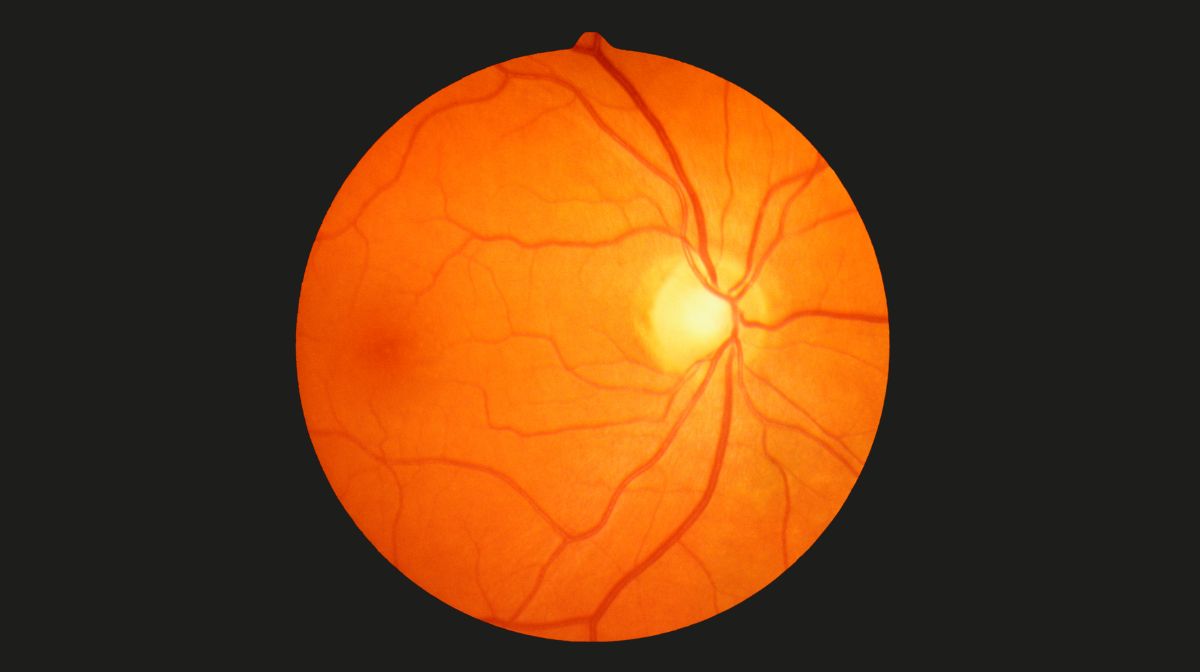 Examination of the retina could detect dementia · Inserm, Science for Health